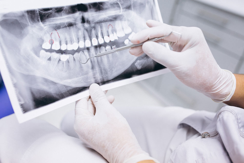 Extraction teeth